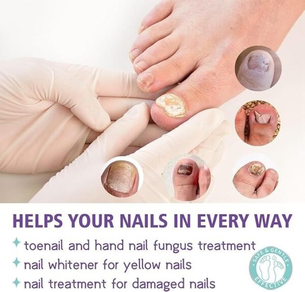Nail Fungus Spray - Image 3
